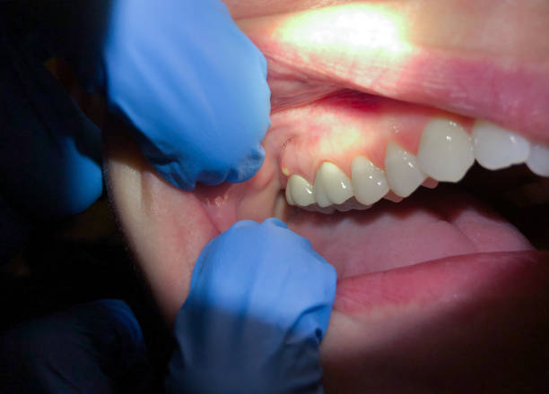 Best Emergency Dentist for Knocked-Out Tooth in Mount Pleasant, TX